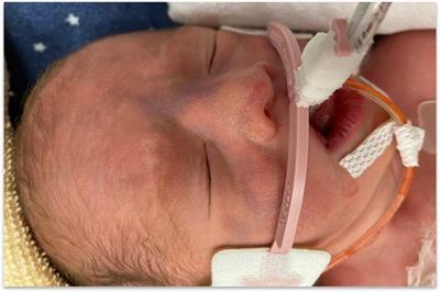Case report: Blotchy skin in a puffy neonate: is there a new association?